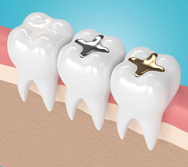 South Gate Composite Fillings