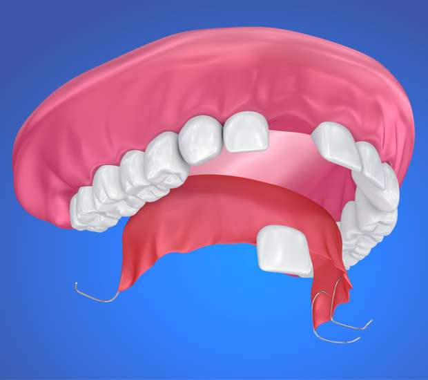 South Gate Partial Denture for One Missing Tooth